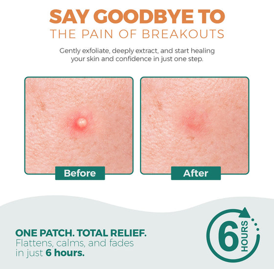 Halo Spot Patch – Invisible Acne Dots (53 Patches)