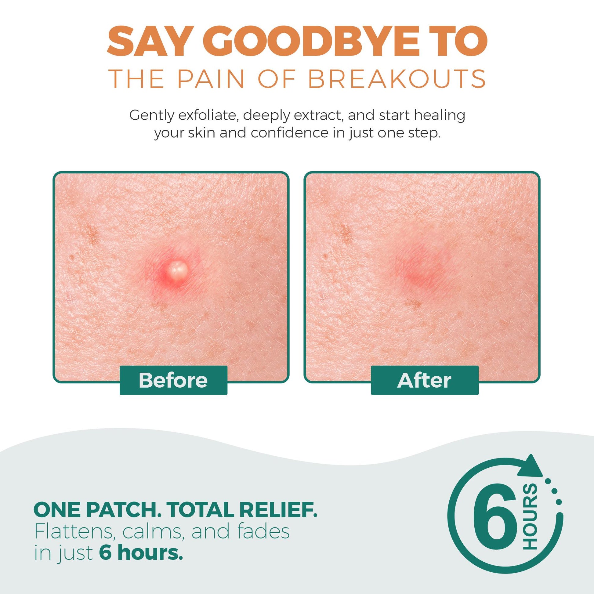 Halo Spot Patch – Invisible Acne Dots (53 Patches)
