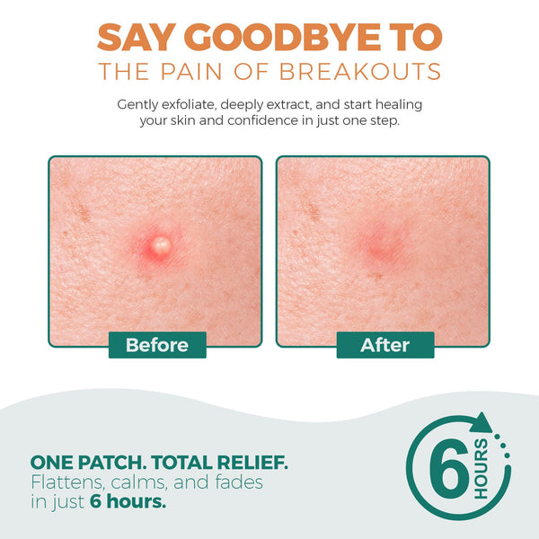 Halo Spot Patch – Invisible Acne Dots (53 Patches)